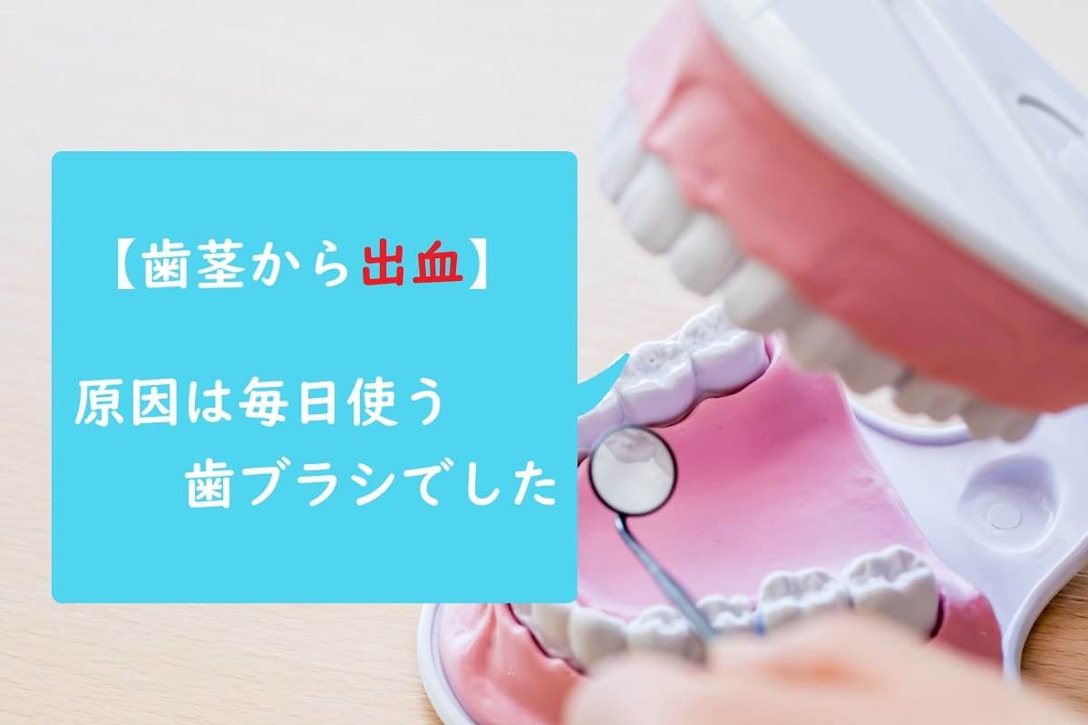 歯茎から出血 原因は毎日使う歯ブラシでした 生活を変えず年間１００万円貯蓄が増える ウシの家計簿主婦ブログー