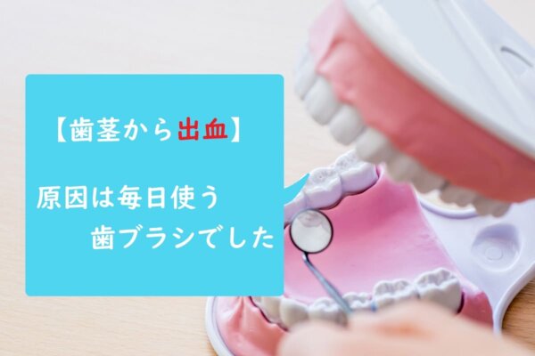 【歯茎から出血】原因は毎日使う歯ブラシでした